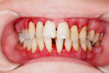 Parodontosebehandlung Zahnarzt Deller